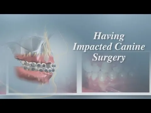 impacted canine teeth